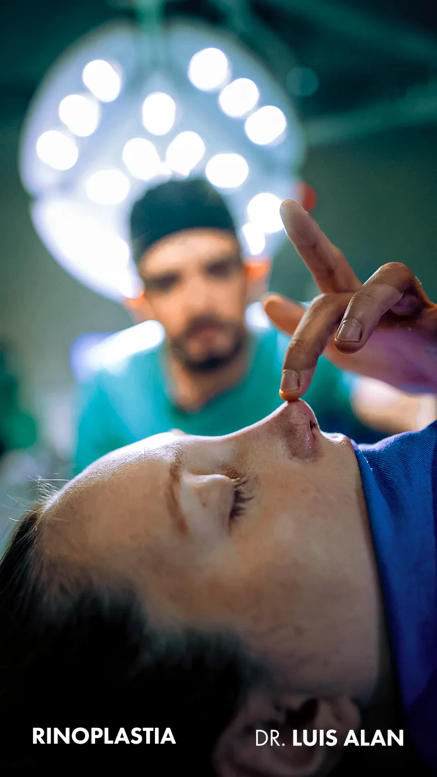Rinoplastia, Dr. Luis Alan